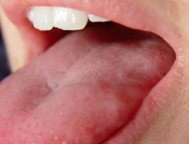 Πρησμένη γλώσσα: Αυτά είναι τα πιθανά σοβαρά αίτια